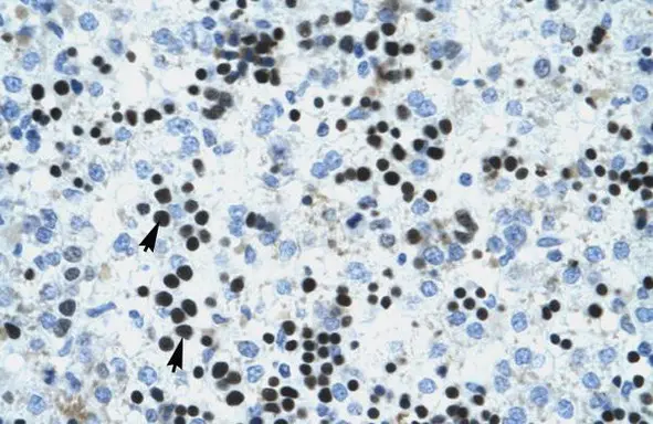 Influenza Virus NS1A Binding Protein (IVNS1ABP) Rabbit Polyclonal Antibody (TA332035)
IHC staining of Human Liver