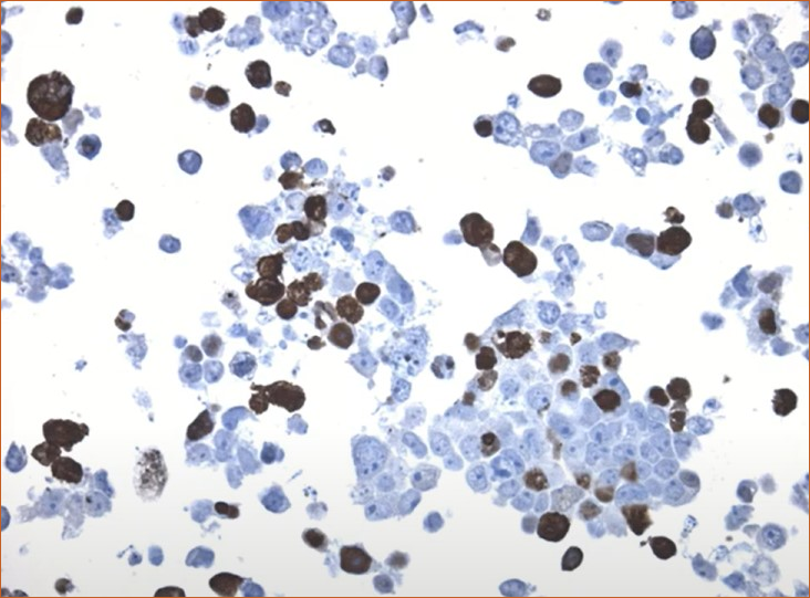 DDK-tag detection of BRG1 in CytoSection (TS426420P5)
