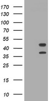 Immunohistochemistry of paraffin-embedded Human esophagus cancer tissue using TA321138 (ALPL Antibody) at dilution 1/240 (Original magnification: ×200)