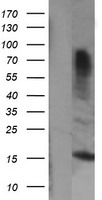 Immunohistochemistry of paraffin-embedded Human breast cancer tissue using TA321652 (pan CDH Antibody) at dilution 1/20 (Original magnification: ×200)