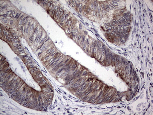 Immunohistochemical staining of paraffin-embedded Adenocarcinoma of Human colon tissue using anti-DBNL mouse monoclonal antibody. (Heat-induced epitope retrieval by 1mM EDTA in 10mM Tris, pH8.5, 120°C for 3min, TA805075)