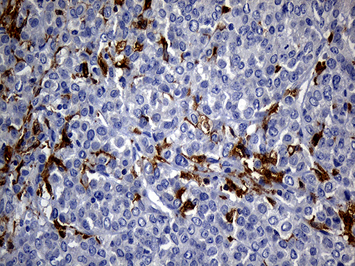 Immunohistochemical staining of paraffin-embedded Adenocarcinoma of Human breast tissue tissue using anti-UBE3B mouse monoclonal antibody. (Heat-induced epitope retrieval by 1mM EDTA in 10mM Tris buffer (pH8.5) at 120°C for 3min, TA806725) (1:250)