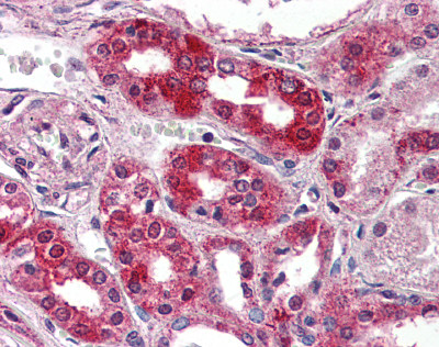 Immunohistochemistry of paraffin-embedded Human esophagus cancer tissue using TA349897 (LIG1 Antibody) at dilution 1/70 (Original magnification: ×200)