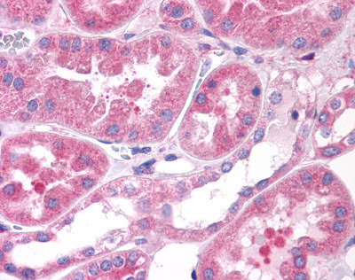 Immunohistochemistry of paraffin-embedded Human liver cancer tissue using TA349907 (DTNB Antibody) at dilution 1/50 (Original magnification: ×200)
