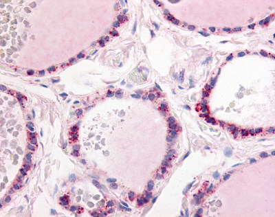 Immunohistochemistry of paraffin-embedded Human breast cancer tissue using TA349910 (DMD Antibody) at dilution 1/30 (Original magnification: ×200)