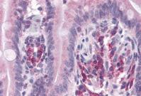 Immunohistochemistry of paraffin-embedded Human liver cancer tissue using TA350948 (SEPTIN4 Antibody) at dilution 1/50 (Original magnification: ×200)