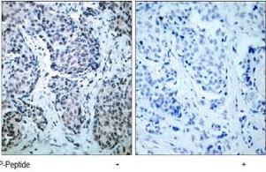 Immunohistochemistry analysis of paraffin-embedded human breast carcinoma tissue using SEK1/MKK4 (phospho-Thr261) antibody.