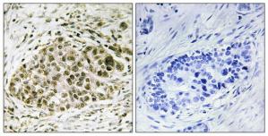 Immunohistochemistry analysis of paraffin-embedded human lung carcinoma tissue, using Lyl-1 antibody.The picture on the right is treated with the synthesized peptide.