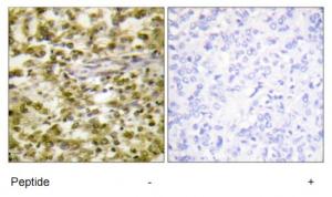 Immunohistochemistry analysis of paraffin-embedded human breast carcinoma tissue, using ERCC6 antibody.The picture on the right is treated with the synthesized peptide.