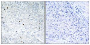 Immunohistochemistry analysis of paraffin-embedded human breast carcinoma tissue, using TP53INP2 antibody.The picture on the right is treated with the synthesized peptide.