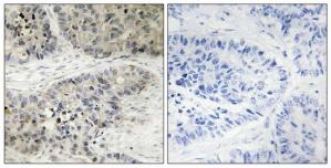 Immunohistochemistry analysis of paraffin-embedded human lung carcinoma tissue, using MAPK15 antibody.The picture on the right is treated with the synthesized peptide.