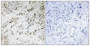 Immunohistochemistry analysis of paraffin-embedded human prostate carcinoma tissue, using TSH2 antibody.The picture on the right is treated with the synthesized peptide.