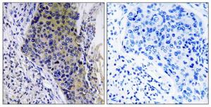 Immunohistochemistry analysis of paraffin-embedded human lung carcinoma tissue using RM34 antibody.The picture on the right is treated with the synthesized peptide.