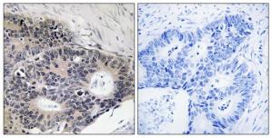 Immunohistochemistry analysis of paraffin-embedded human colon carcinoma tissue using ABHD12B antibody.The picture on the right is treated with the synthesized peptide.