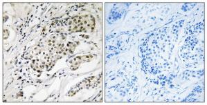 Immunohistochemistry analysis of paraffin-embedded human breast carcinoma tissue using CDYL2 antibody.The picture on the right is treated with the synthesized peptide.