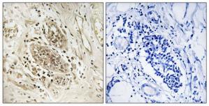 Immunohistochemistry analysis of paraffin-embedded human breast carcinoma tissue using POLE1 antibody.The picture on the right is treated with the synthesized peptide.