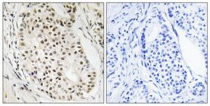 Immunohistochemistry analysis of paraffin-embedded human breast carcinoma tissue using HNRNPUL2 antibody.The picture on the right is treated with the synthesized peptide.