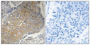 Immunohistochemistry analysis of paraffin-embedded human lung carcinoma tissue using MRPS33 antibody.The picture on the right is treated with the synthesized peptide.
