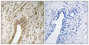 Immunohistochemistry analysis of paraffin-embedded human breast carcinoma tissue using PHF3 antibody.The picture on the right is treated with the synthesized peptide.