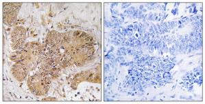 Immunohistochemistry analysis of paraffin-embedded human colon carcinoma tissue using LUC7L2 antibody.The picture on the right is treated with the synthesized peptide.