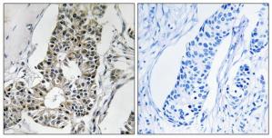 Immunohistochemistry analysis of paraffin-embedded human breast carcinoma tissue using RIMS4 antibody.The picture on the right is treated with the synthesized peptide.
