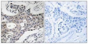 Immunohistochemistry analysis of paraffin-embedded human breast carcinoma tissue using SEC16A antibody.The picture on the right is treated with the synthesized peptide.