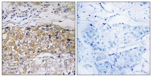 Immunohistochemistry analysis of paraffin-embedded human breast carcinoma tissue using USP24 antibody.The picture on the right is treated with the synthesized peptide.