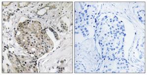 Immunohistochemistry analysis of paraffin-embedded human breast carcinoma tissue using USP40 antibody.The picture on the right is treated with the synthesized peptide.