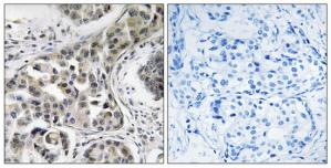 Immunohistochemistry analysis of paraffin-embedded human breast carcinoma tissue using USP6NL antibody.The picture on the right is treated with the synthesized peptide.