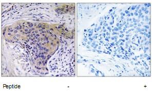 Immunohistochemistry analysis of paraffin-embedded human lung carcinoma tissue using SLC30A2 antibody.The picture on the right is treated with the synthesized peptide.