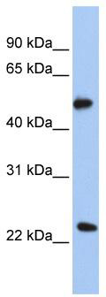 Immunohistochemistry of paraffin-embedded Human colon cancer tissue using TA369099 (KIAA1324 Antibody) at dilution 1/30 (Original magnification: ×200)