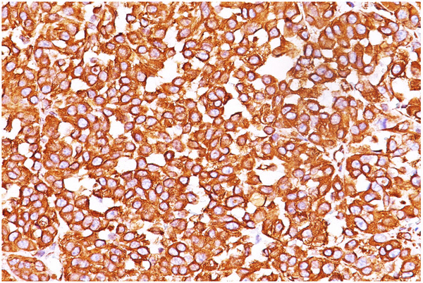 Formalin-paraffin human melanoma stained with Vimentin Antibody (Clone VM452).