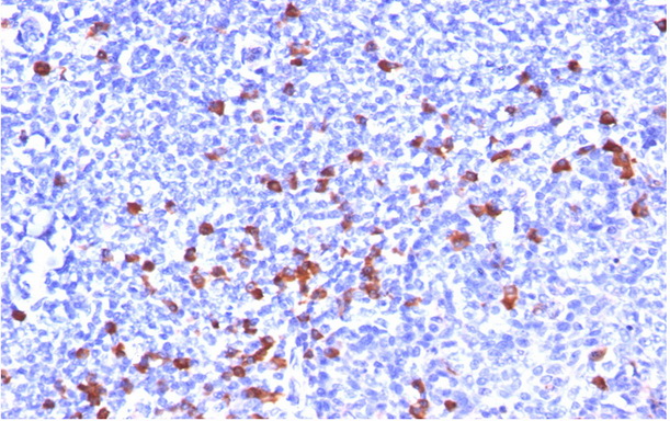 Formalin-Fixed, Paraffin-Embedded Human tonsil stained with Kappa Antibody (Clone L1C1). Note cell membrane and cytoplasmic staining.