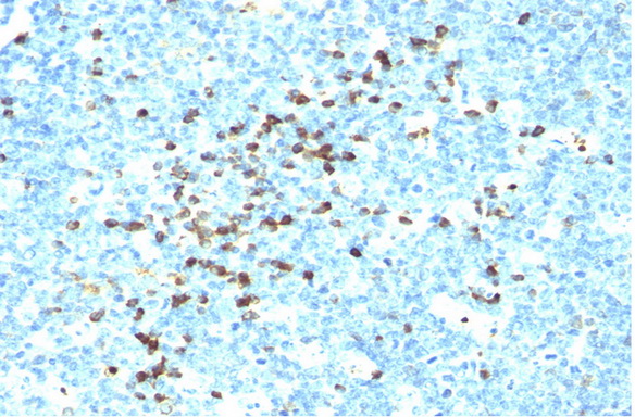 Formalin-Fixed, Paraffin-Embedded Human tonsil stained with Lambda Antibody Cat.-No AM33322PU (Clone LAM03).Note cell membrane and cytoplasmic staining.