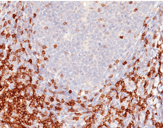 Formalin-Fixed, Paraffin-Embedded Human tonsil stained with CD5 Antibody (Clone C5/473 + CD5/54/F6).