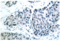 Immunohistochemistry (IHC) analysis of SEK1/MKK4 pThr261 antibody (Cat.-No.: AP01679PU-N) in paraffin-embedded human breast carcinoma tissue.