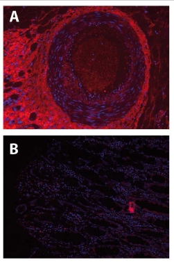 Immunofluorescence Image of Calprotectin staining of Paraffin Section of Human colon carcinoma. The section was incubated with AP02119SU at 1/500 dilution followed by incubation with Cy3-labeled Goat anti Rabbit antibody. Figure A: AP02119SU staining of co Immunofluorescence Image of Calprotectin staining of Paraffin Section of Human colon carcinoma. The section was incubated with AP02119SU at 1/500 dilution followed by incubation with Cy3-labeled Goat anti Rabbit antibody. Figure A: AP02119SU staining of co