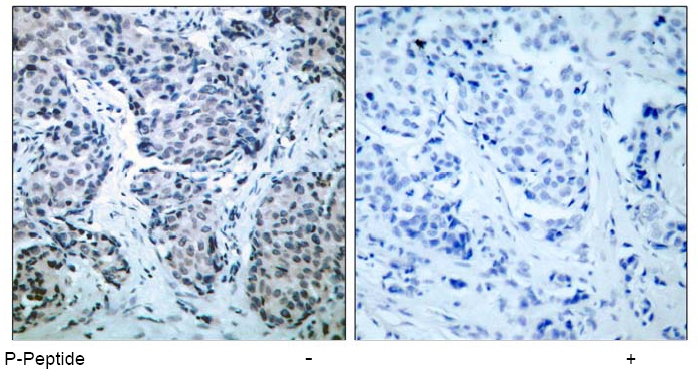 Figure 1. Immunohistochemical analysis of paraffin-embedded human breast carcinoma tissue, using SEK1/MKK4 (phospho-Thr261) antibody.