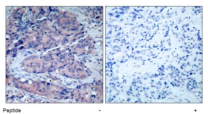 Figure 1. Immunohistochemical analysis of paraffin-embedded human breast carcinoma tissue, using SEK1/MKK4 antibody.