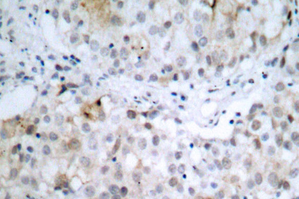 Immunohistochemistry (IHC) analyzes of HER2 antibodyinparaffin-embedded human breast carcinoma tissue.