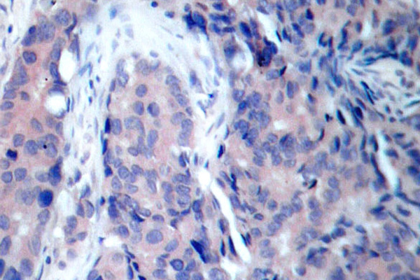 Immunohistochemistry (IHC) analysis of SEK1/MKK4 antibody in paraffin-embedded human breast carcinoma tissue.