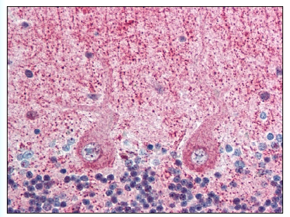 Figure 1. EIF3F antibody staining of Formalin-Fixed Paraffin-Embedded Human Brain, cerebellum at 2.5 ug/ml followed by biotinylated Goat anti-Rabbit IgG secondary antibody, Alkaline Phosphatase-Streptavidin and Chromogen.