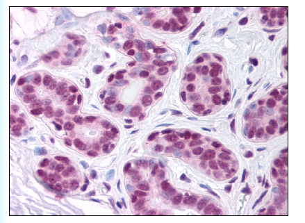 Figure 1. Staining SUPT16H in Breast by Immunohistochemistry using Formalin-Fixed Paraffin-Embedded (FFPE) tissue.