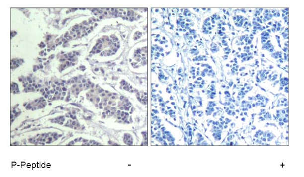 Figure 1. Immunohistochemical analysis of paraffin-embedded human breast carcinoma tissue using AKT1/AKT2/AKT3 (Phospho-Tyr315/316/312) Antibody.