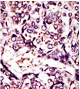Formalin-fixed and paraffin-embedded human cancer tissue reacted with the primary antibody, which was peroxidase-conjugated to the secondary antibody, followed by DAB staining. This data demonstrates the use of this antibody for immunohistochemistry; clinical relevance has not been evaluated.