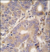 Formalin-fixed and paraffin-embedded human hepatocarcinoma tissue reacted with CARS2 antibody (C-term), which was peroxidase-conjugated to the secondary antibody, followed by DAB staining.