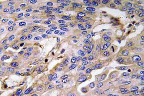 Formalin fixed paraffin embedded human gastrointestinal stromal tumor stained with CD117/c-kit antibody (Cat. #DP063)