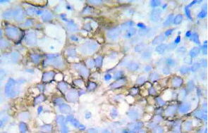 Human SH-SY5Y cells stained with Fibrillarin/Nop1p showing prominent specular nucleolar staining. The nuclei are counter stained with blue DAPI DNA stain, so these spots appear very pale blue. Cells are also stained with Neurofilament NF-H.