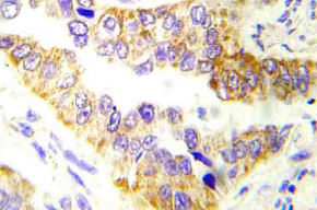 Immunohistochemistry (IHC) analyzes of Tsc2 antibody in paraffin-embedded human lung carcinoma tissue. Immunohistochemistry (IHC) analyzes of Tsc2 antibody in paraffin-embedded human lung carcinoma tissue.