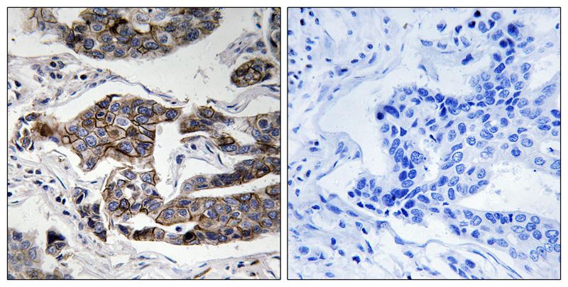 Immunohistochemical analysis of paraffin-embedded human breast carcinoma tissue using Girdin (Phospho-Ser1417) Antibody (left)or the same antibody preincubated with blocking peptide (right).